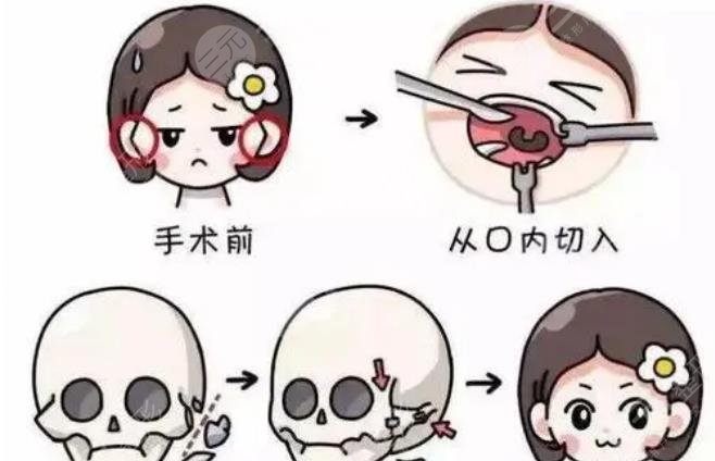 消除下頜角手術(shù)風(fēng)險(xiǎn)大嗎