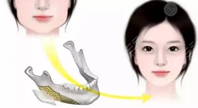 消除下頜角手術(shù)風(fēng)險(xiǎn)大嗎