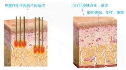多維除皺真的有用嗎？