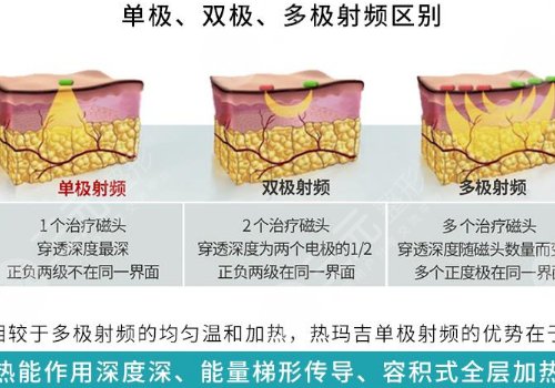 雙cwt熱瑪吉與普通熱瑪吉什么區(qū)別？
