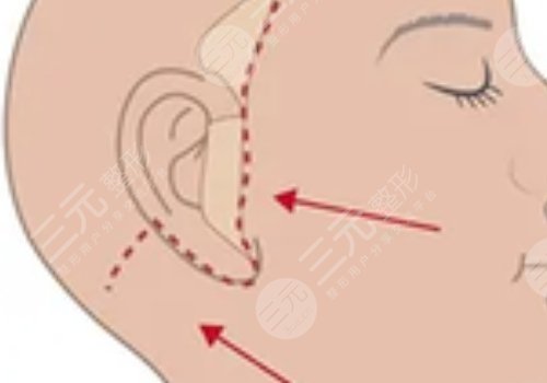 北京黃寺醫(yī)療美容診所做拉皮手術(shù)好嗎?
