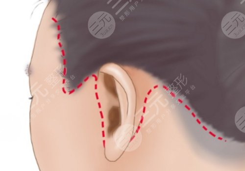 北京黃寺醫(yī)療美容診所做拉皮手術(shù)好嗎?