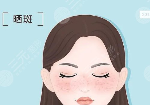 曬斑如何淡化或去掉？
