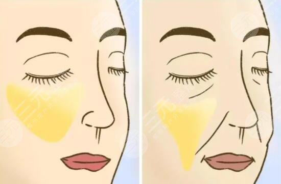 面部下垂整形手術(shù)安全嗎?