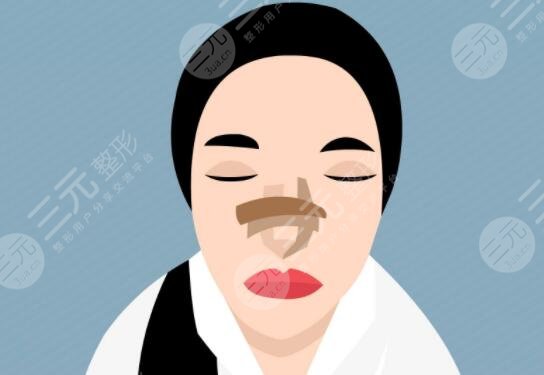 自體軟骨隆鼻好嗎有效果嗎？材料優(yōu)勢/價格多少錢/注意事項