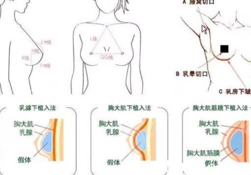 隆胸乳暈切口的優(yōu)缺點