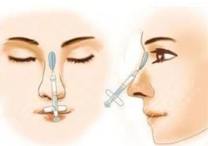 玻尿酸隆鼻有副作用嗎