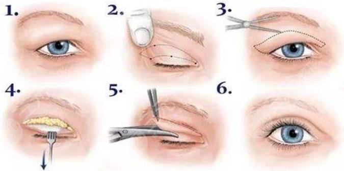 雙眼皮修復(fù)