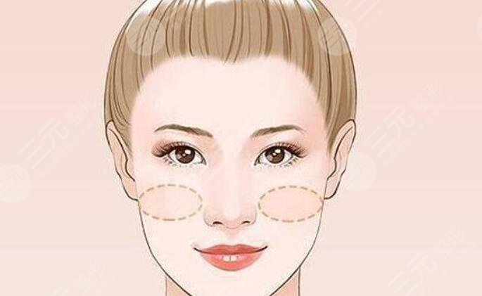 蘋果肌復(fù)位