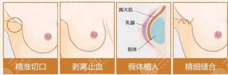 曼托豐胸