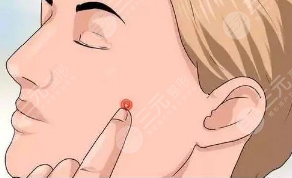 激光磨皮去痘印多少錢一般？術(shù)后注意飲食合理搭配，加固效果！