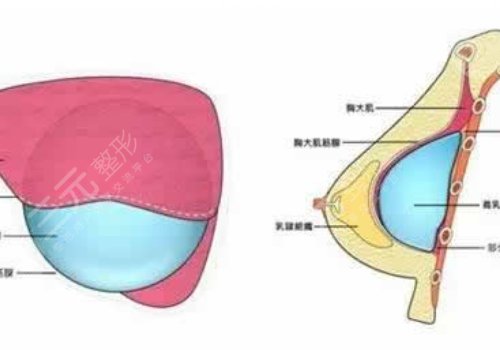 假體豐胸如何避免包膜痙攣？