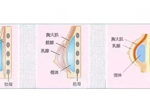假體豐胸如何避免包膜痙攣？