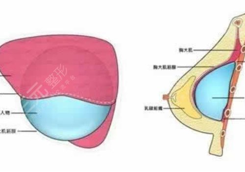 光面假體隆胸后需要怎么樣按摩？
