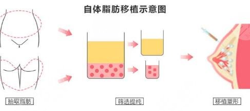 瘦腰豐胸的醫(yī)美方法