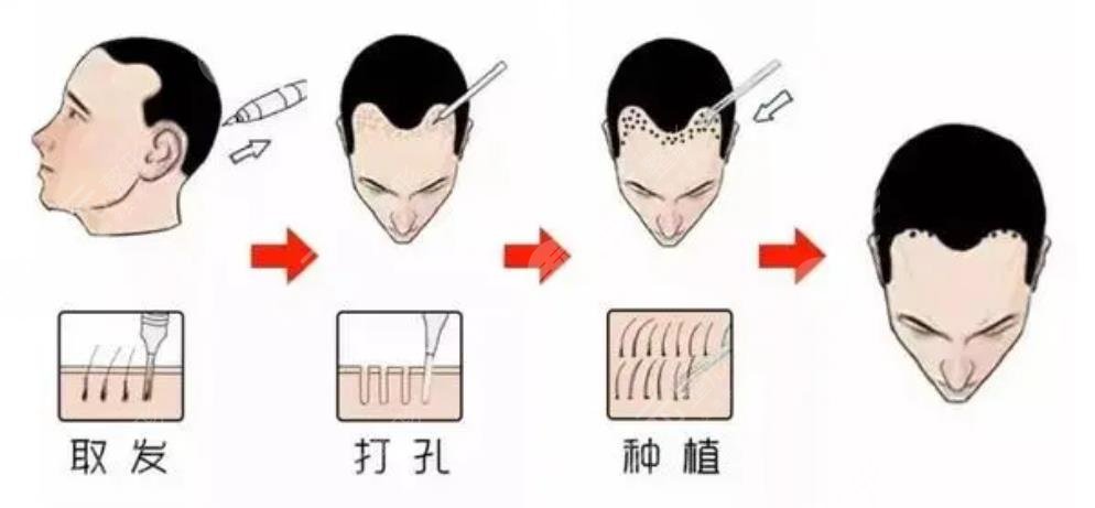 植發(fā)