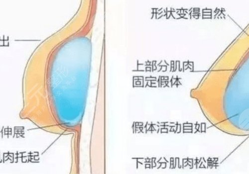 德國(guó)寶儷假體和傲諾拉哪個(gè)手感好？