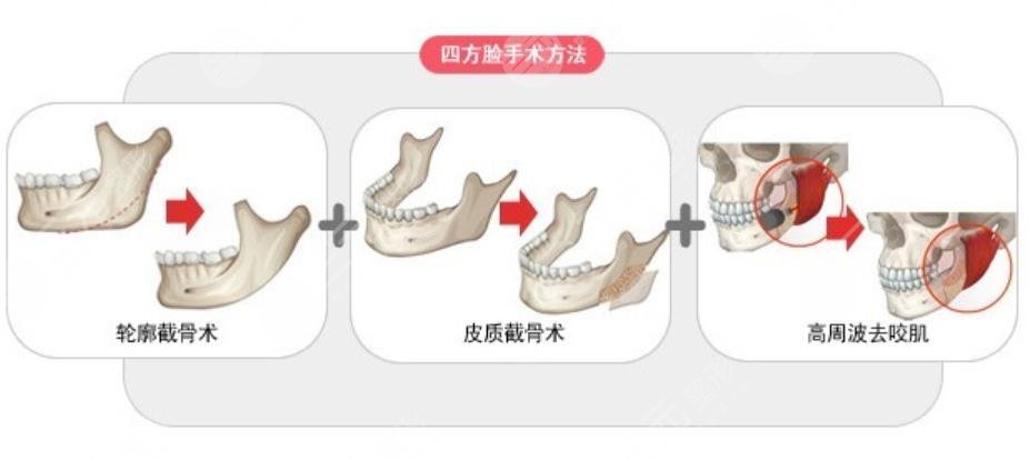 下頜角整形