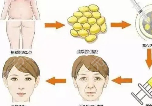 面部脂肪填充多久能恢復(fù)自然？
