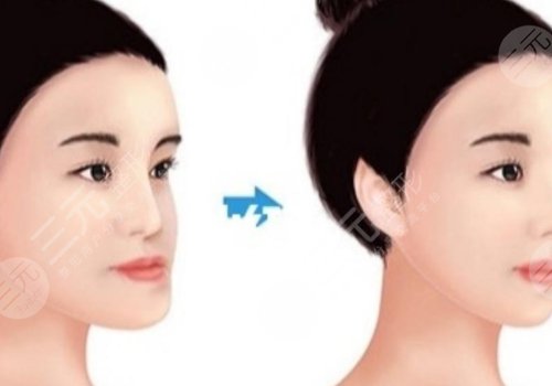 面部輪廓整形包括哪些項目？