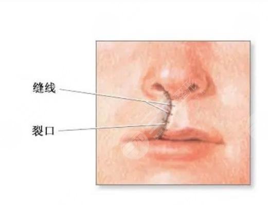 唇裂修復