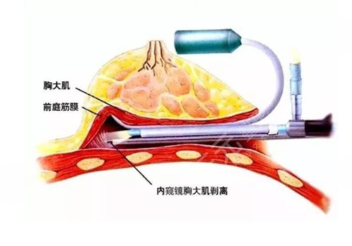 雙平面內(nèi)窺鏡隆胸幾天能不疼？