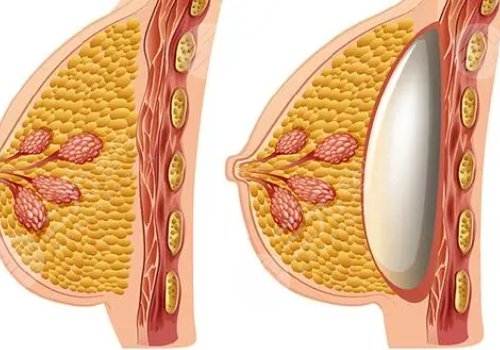 雙平面內(nèi)窺鏡隆胸幾天能不疼？