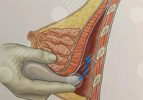 雙平面內(nèi)窺鏡隆胸幾天能不疼？