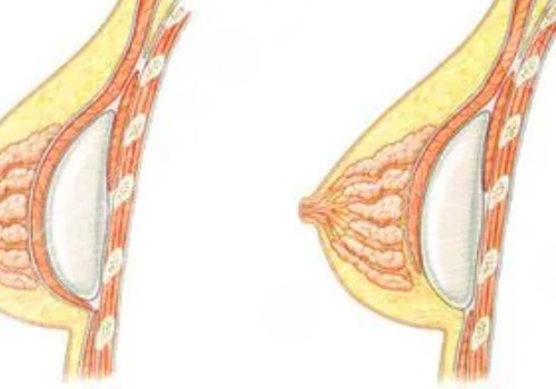 雙平面內(nèi)窺鏡隆胸幾天能不疼？