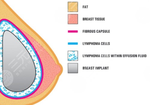 雙平面內(nèi)窺鏡隆胸幾天能不疼？