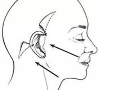 大拉皮手術(shù)15天是什么樣子？