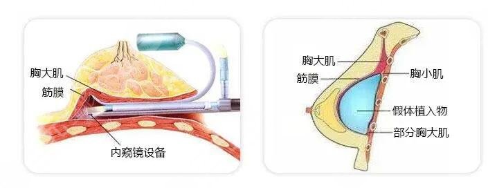 內(nèi)窺鏡隆胸技術(shù)安全嗎?