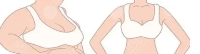 背部吸脂