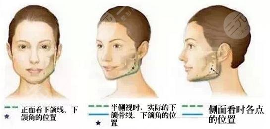 面部輪廓整形有什么后遺癥？