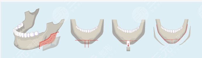 面部輪廓整形有什么后遺癥？