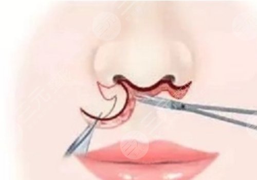 縮短人中的幾種方法