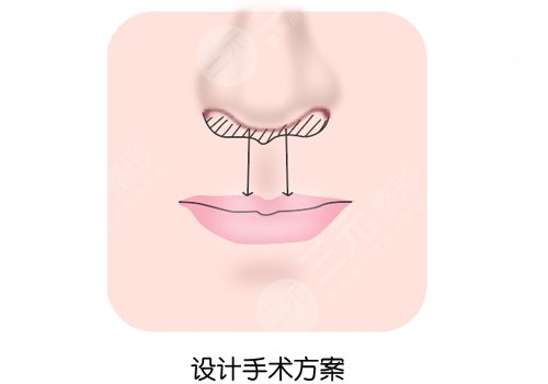 縮短人中手術(shù)會留疤嗎？