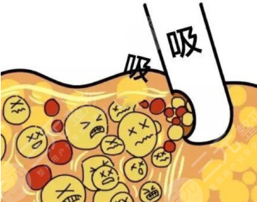 全身抽脂50斤的價格要5w？