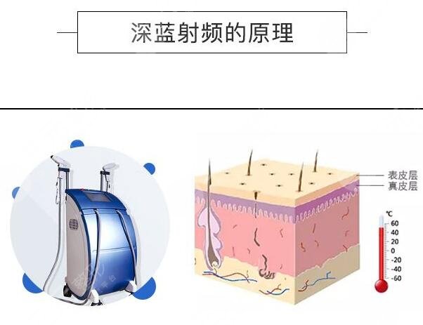 深藍射頻原理是什么?