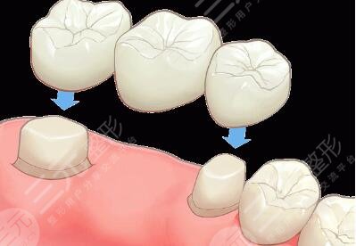 烤瓷牙修復(fù)能美白牙齒嗎？多少錢(qián)？使用壽命是幾年？
