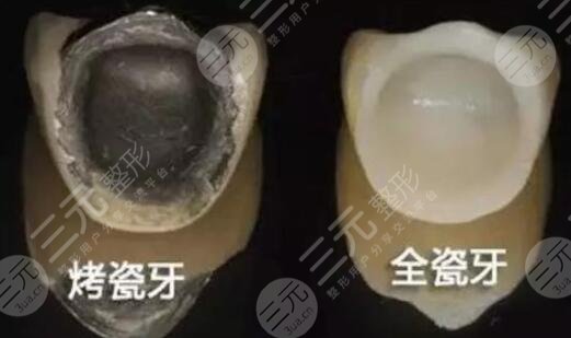 烤瓷美白牙齒多少錢(qián)?