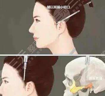 顴骨