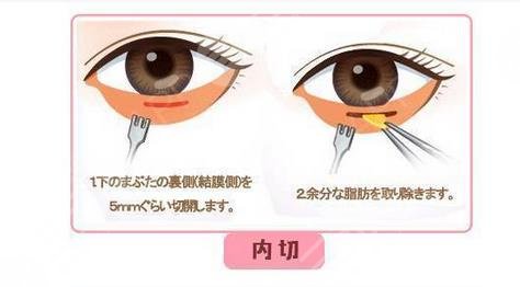內(nèi)切眼袋能保持幾年