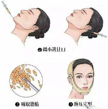 臉部吸脂肪大概需要多少錢？價格表公開！3家正規(guī)醫(yī)院介紹~