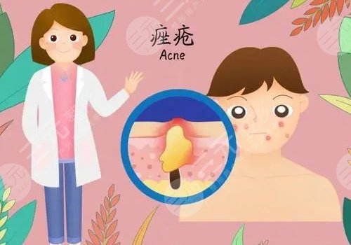 祛痘痘疤藥膏哪個好?