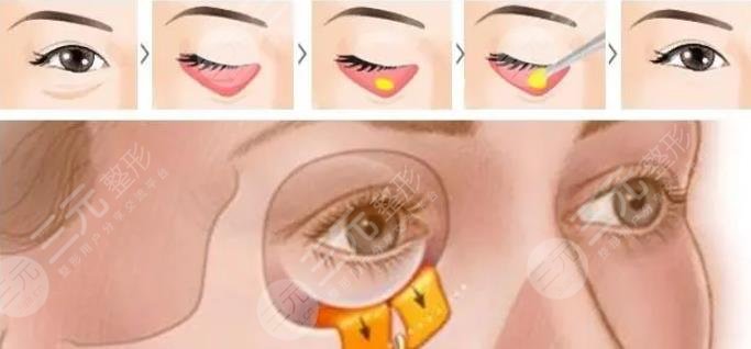 內(nèi)切眼袋多久可以戴隱形眼鏡