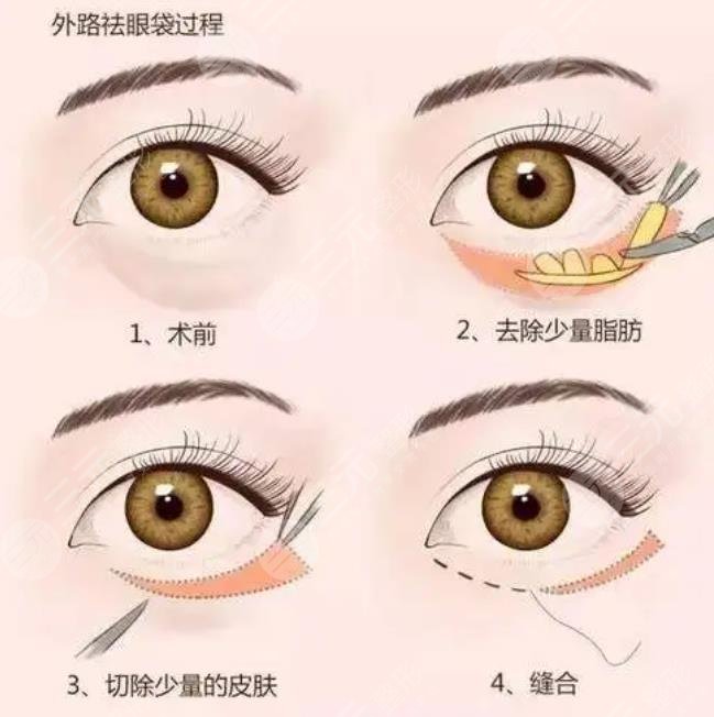 外切眼袋恢復(fù)過程圖