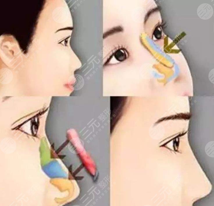 大鼻子整形一般多少錢