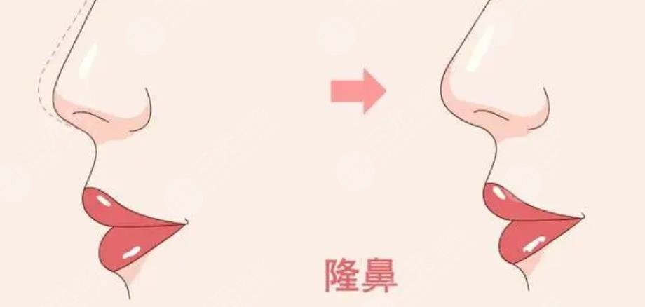 大鼻子整形一般多少錢