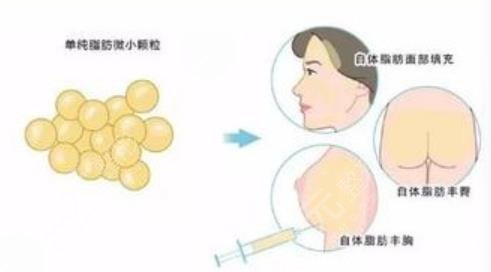 自體填充